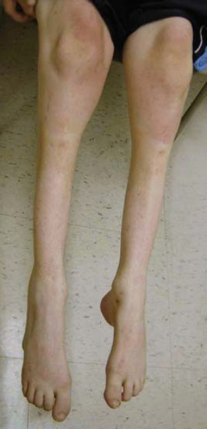 polinevrop3 Наследственная полиневропатия