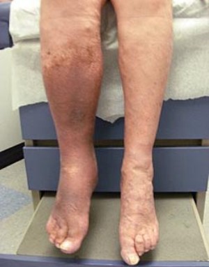 posttromb2 posttromb2