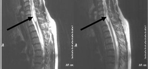 siringomiel2 siringomiel2