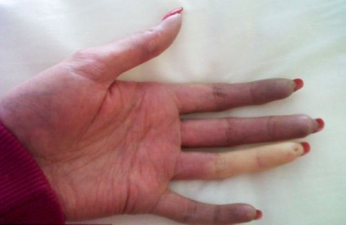 sist-sklerod sist-sklerod