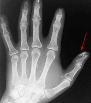 sist-sklerod2 sist-sklerod2