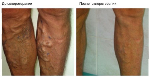 skleroter2 skleroter2