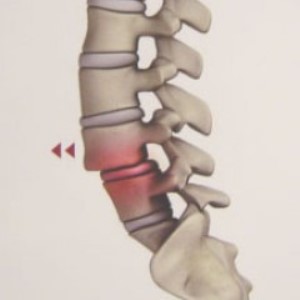 spondilolis2 spondilolis2