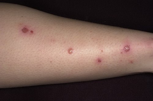 streptoder-vz streptoder-vz