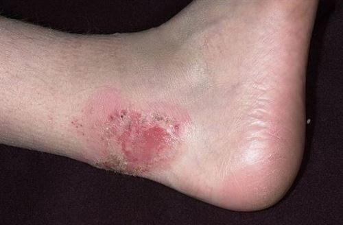 streptoder-vz2 streptoder-vz2