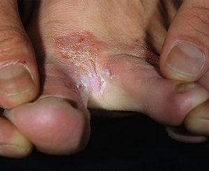 treshini-palc treshini-palc