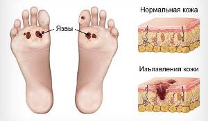 trof-yazv2 trof-yazv2