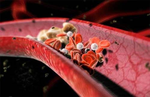 tromb-sosud tromb-sosud