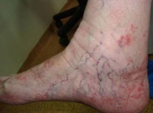 tromb-ven2 tromb-ven2