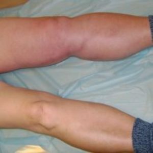 tromb-ven3 tromb-ven3