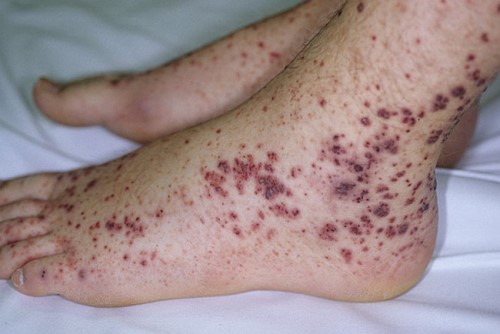 trombocitop trombocitop