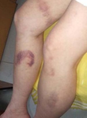 trombocitop2 trombocitop2