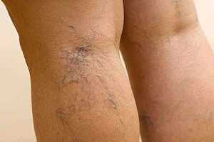 varikoz-gv varikoz-gv