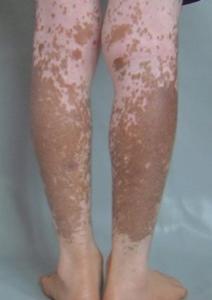vitiligo vitiligo