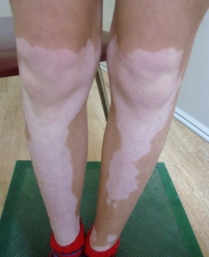 vitiligo2 vitiligo2