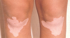 vitiligo3 vitiligo3